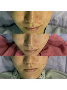 ラマリマ(Lamalima)/顧客限定ハーブピーリング