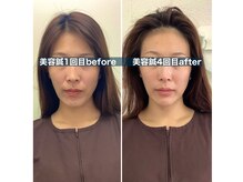 ハリサロンドオフ 堺東店(hari salon de off)/お客様before→after
