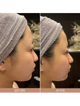 ビーエヌ エステティックアンドスパ(BN Esthetic&Spa)/小顔コルギ