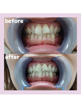 パレ 大阪十三店(Palet)/2回照射後のbefore/after