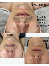 シロ(SHIRO)/お髭脱毛