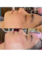 サロンドウルス(salon de ours)/エクソソーム