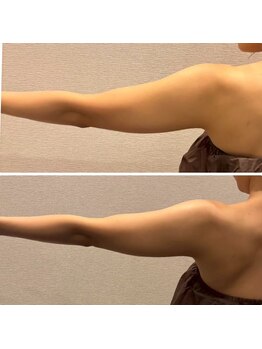 ビュウナ 銀座(BEAUNA)/マルチウェーブリフト