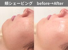 ももとゆでたまご/顔剃り ビフォーアフター/新宿