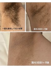 ヴィプラス(VIPLUZ)/脇脱毛の効果