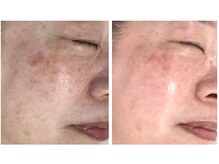 レクラ バイ ドクターエイチ(L'ECLAT by Doctor.H)/無針水光注入”美容液真皮導入”