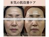 肌改善ケア【お肌悩み全般】13,200円⇒