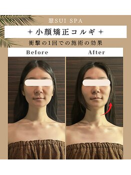 ブライダルエステ バイ スイスパ表参道(BRIDAL ESTHE by SUI SPA)/【小顔矯正】小顔 Before→After