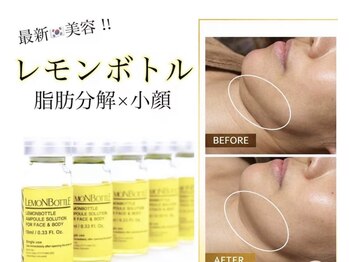 もも リフレッシュの写真/【レモンボトル噂の小顔脂肪分解】が叶える！二重あご・口横ポニョケアで自信あふれる小顔美人に☆