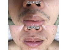 ナゴミ 金沢店(nagomi)の雰囲気（自己処理を確実に減らす施術★お悩みや理想をお聞かせください♪）