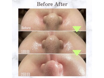 エステサロン アンジュール(Angelle)/回数を重ねるごとに