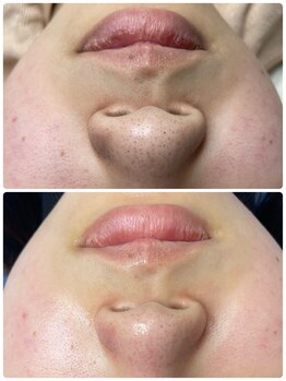 KMB 恵比寿店/毛穴洗浄+顔脱毛