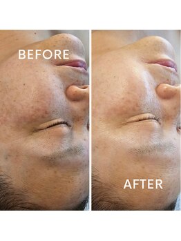 水光ピールスキン/水光ピーリング初回体験前後