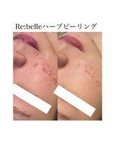 サラ/Re:belleハーブピーリング