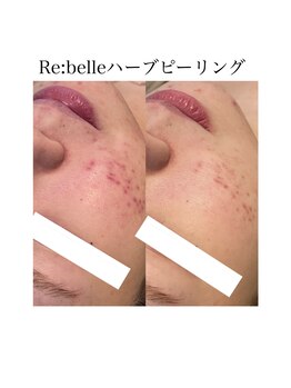 サラ/Re:belleハーブピーリング