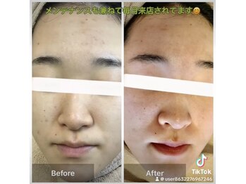 モカ 天王寺店(MOKA)/おでこニキビケア　シミケア