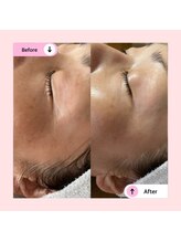 アネラ(ANELA)/シワ　たるみ