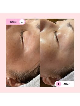 アネラ(ANELA)/シワ　たるみ