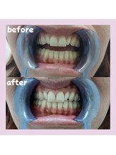 パレ 大阪十三店(Palet)/２回照射後のbefore/after