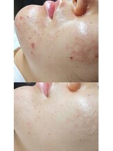 ルミナエステ(LUMINA ESTH)/ハーブピーリング／川口