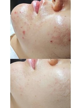 ルミナエステ(LUMINA ESTH)/ハーブピーリング/川口