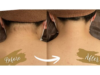 チャンティック(Cantik)/ブライダル脱毛