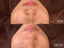 ウォーム(warm)/シミケア/美白/脱ピーリング