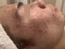 オアシスラグーン(OASIS LAGOON)/ニキビケア（症例５：before）