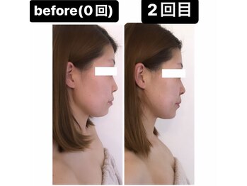 アンドモア(&more)/小顔症例