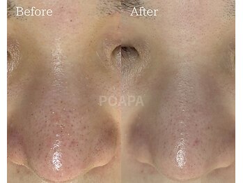 ポアラ(POARA)/毛穴/ワックス脱毛