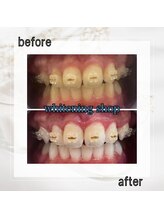 ホワイトニングショップ 亀戸店/【亀戸】美白ホワイトニング