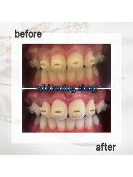 ホワイトニングショップ 亀戸店/【亀戸】美白ホワイトニング