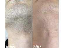 グレイス(Grace)/メンズひげ脱毛