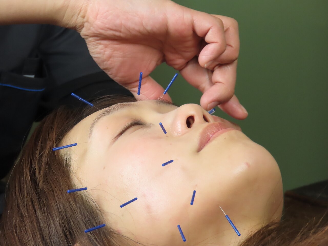 花巻希少★30〜70代女性に大好評◎しわ・たるみ・ほうれい線改善に!美容鍼