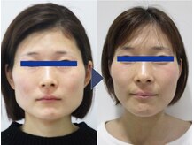 美デザイン 自由が丘店(美.design)/☆小顔矯正+頭蓋骨矯正+首肩矯正