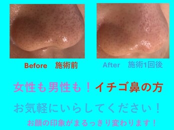 リュクス(LUXE)/イチゴ鼻　解消術