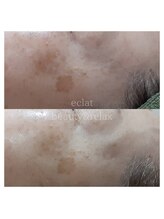 エクラ(eclat)/ハーブトリートメント