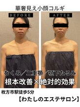 わたしの 大阪枚方本店/二重顎、顎下たるみスッキリ改善