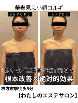 わたしの 大阪枚方本店/二重顎、顎下たるみスッキリ改善