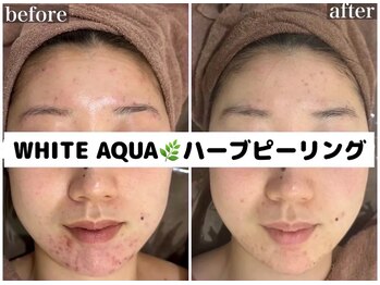ホワイトアクア 柏店(WHITE AQUA)/ハーブピーリング/ニキビケア