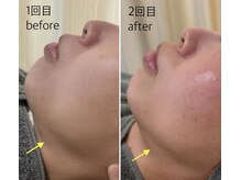 ほねつぎ一休さん 宇品店/小顔フェイシャル