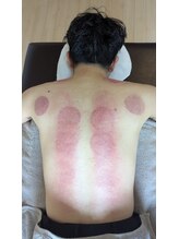 ハルシオン/カッピング・吸い玉・吸角の痕