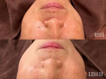 ウォーム(warm)/シミケア/美白/脱ピーリング