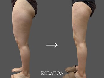 【次世代脂肪冷却・小顔ハイリフト専門店】ECLATOA　四日市/痩身/ダイエットの写真/【美脚集中】落ちにくい太ももやヒップの脂肪を狙い撃ち！
次世代・脂肪冷却×EMSで憧れの美脚へ★