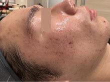 オアシスラグーン(OASIS LAGOON)/ニキビケア（症例５：after）