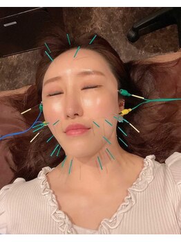 ロミハリ(LomiHari)/当サロン自慢の美容鍼