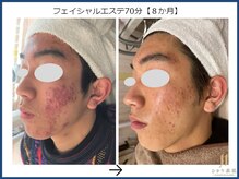 ひかり素肌/フェイシャルエステ 8か月