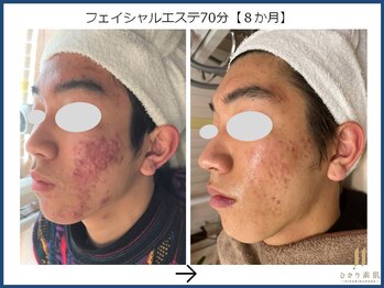 ひかり素肌/フェイシャルエステ 8か月
