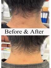 シャイニー/えりあし脱毛５回