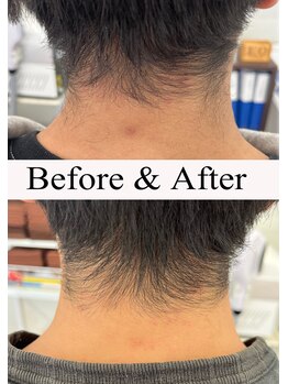 シャイニー/えりあし脱毛5回